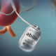 Illustration for article titled Pacemaker Zaps Stomach Internally to Prevent Overindulging